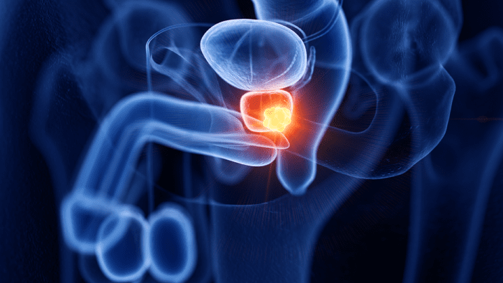 ADOBE prostate cancer
